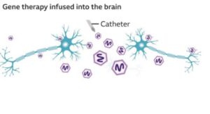 first successful treatment of Huntington's disease