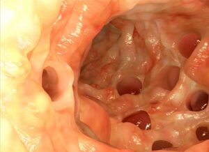 diverticulitis symptoms