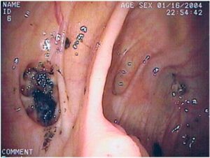 diverticulitis stool appearance