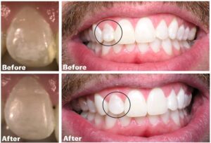early signs of cavities