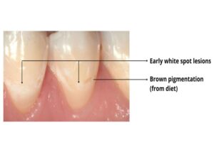 what cavities look like